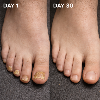 Nailex™ Fungus Serum