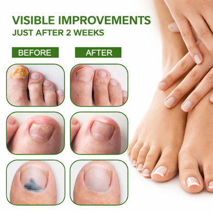 Nailex™ Fungus Serum